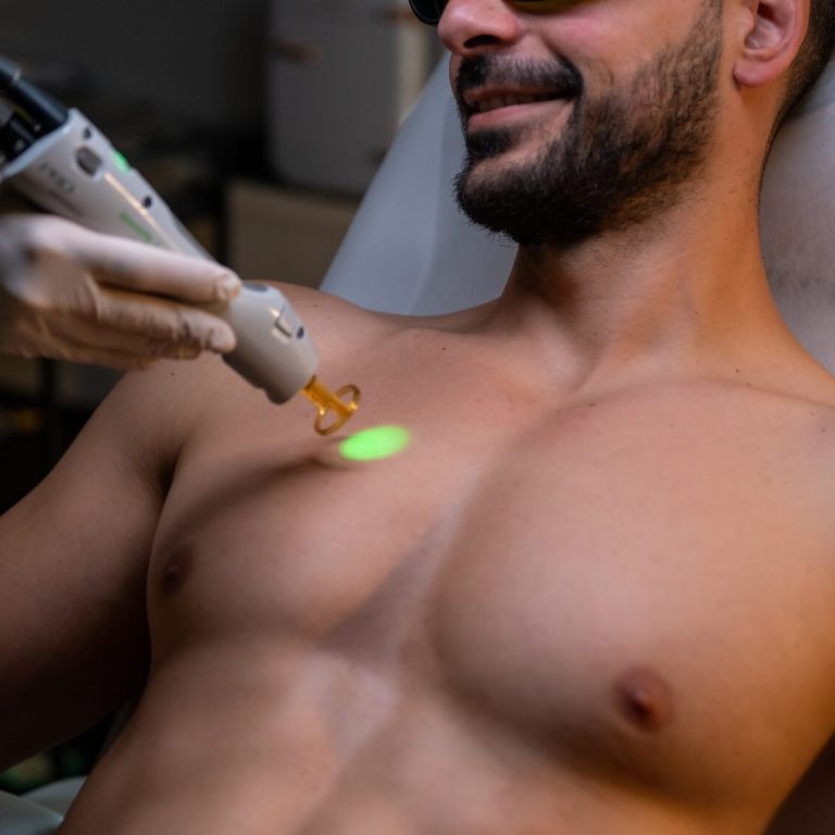 laser alexandritis bareskin
